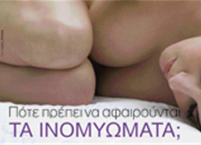 Πότε πρέπει να αφαιρούνται τα ινομυώματα; Πότε πρέπει να αφαιρούνται τα ινομυώματα;